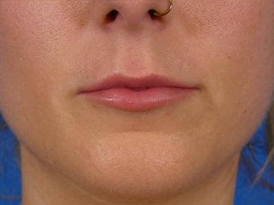 Lip Filler Before & After Gallery - Patient 389038 - Image 2
