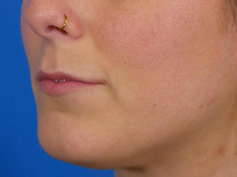 Lip Filler Before & After Gallery - Patient 389038 - Image 3