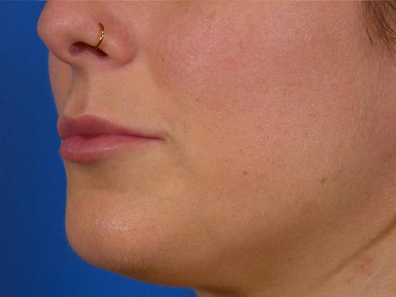 Lip Filler Before & After Gallery - Patient 389038 - Image 4