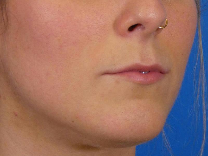Lip Filler Before & After Gallery - Patient 389038 - Image 5