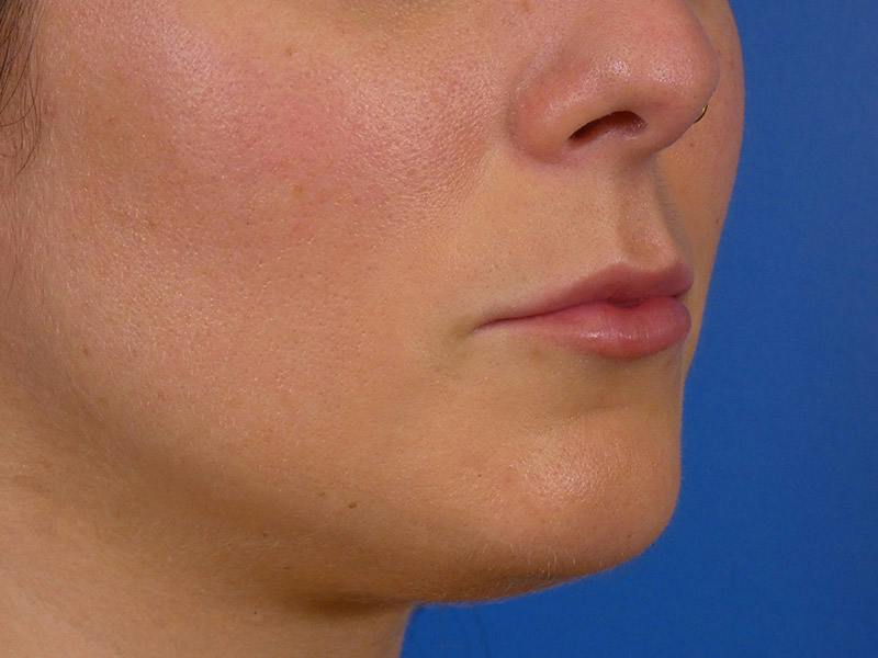 Lip Filler Before & After Gallery - Patient 389038 - Image 6