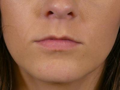 Lip Filler Before & After Gallery - Patient 165304 - Image 1
