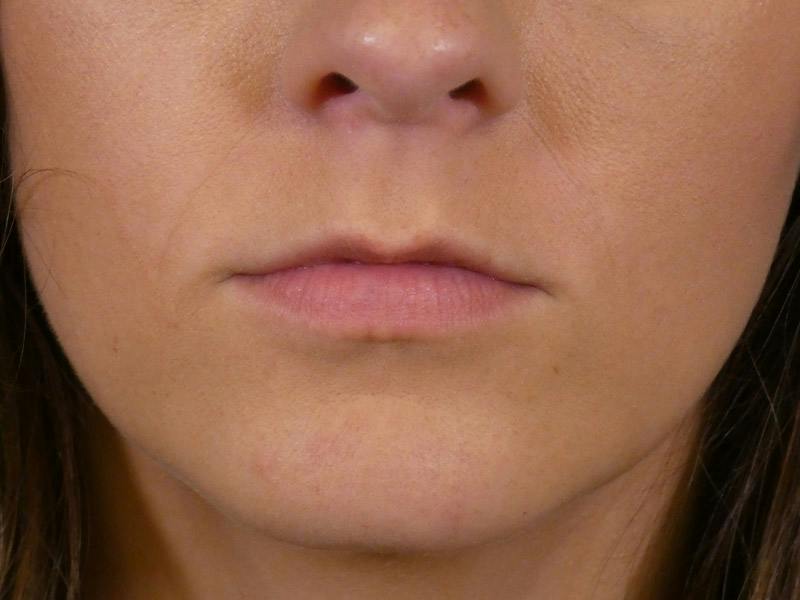 Lip Filler Before & After Gallery - Patient 165304 - Image 1