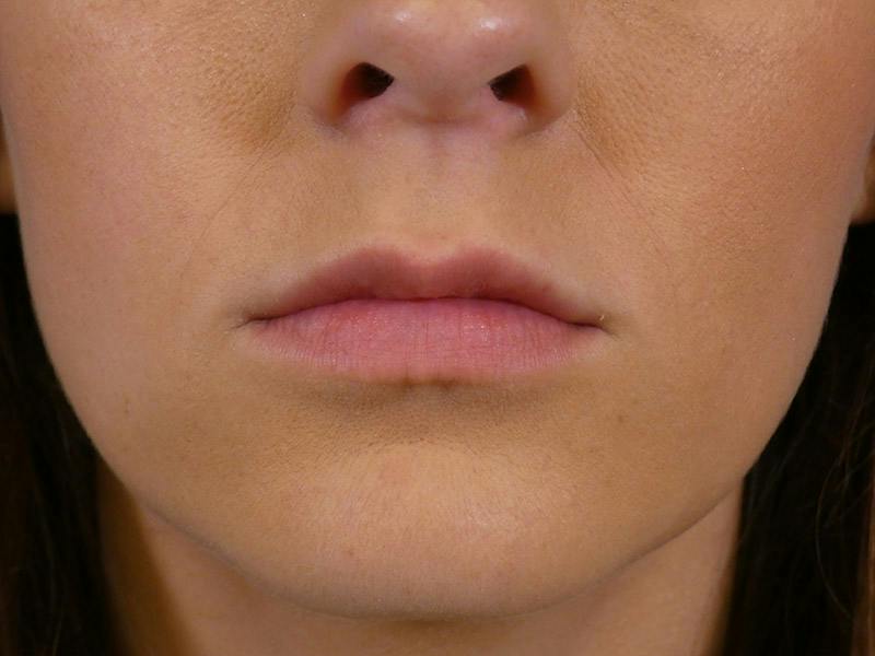Lip Filler Before & After Gallery - Patient 165304 - Image 2