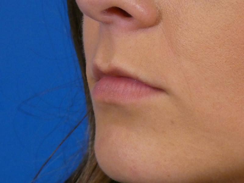 Lip Filler Before & After Gallery - Patient 165304 - Image 3