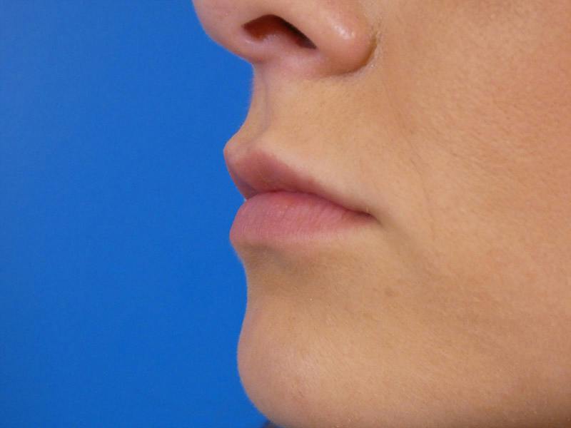 Lip Filler Before & After Gallery - Patient 165304 - Image 4