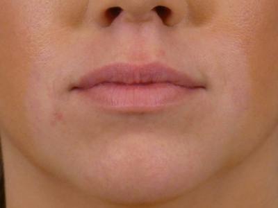 Lip Filler Before & After Gallery - Patient 265123 - Image 1