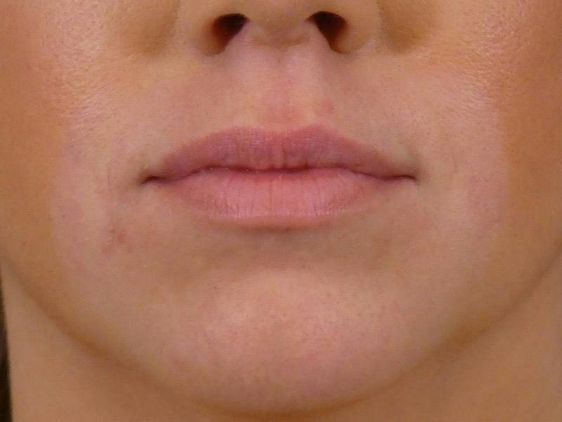 Lip Filler Before & After Gallery - Patient 265123 - Image 1