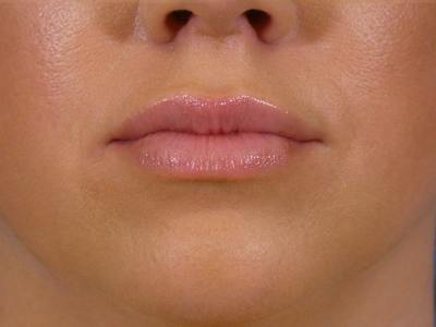 Lip Filler Before & After Gallery - Patient 265123 - Image 2