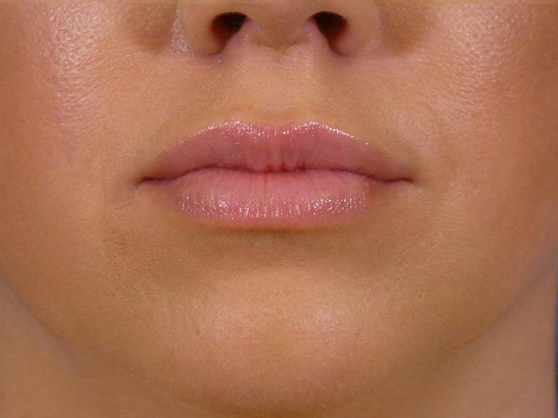 Lip Filler Before & After Gallery - Patient 265123 - Image 2