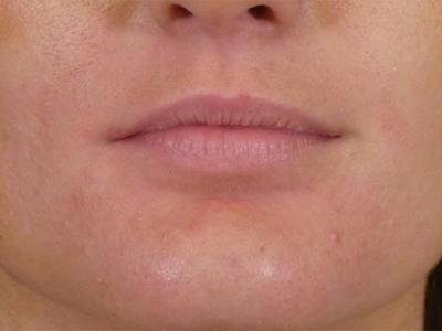 Lip Filler Before & After Gallery - Patient 865840 - Image 1