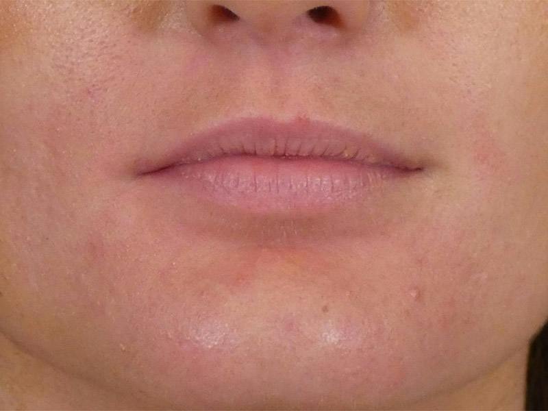 Lip Filler Before & After Gallery - Patient 865840 - Image 1