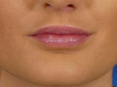 Lip Filler Before & After Gallery - Patient 865840 - Image 2