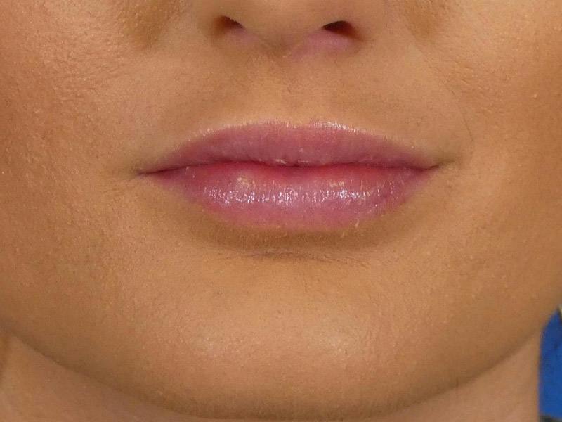 Lip Filler Before & After Gallery - Patient 865840 - Image 2