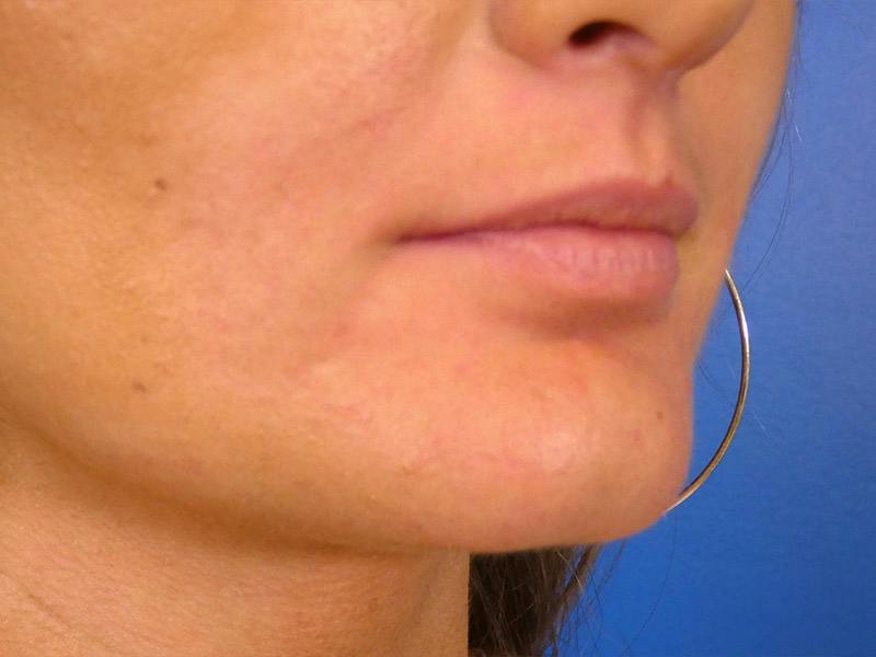 Lip Filler Before & After Gallery - Patient 865840 - Image 3