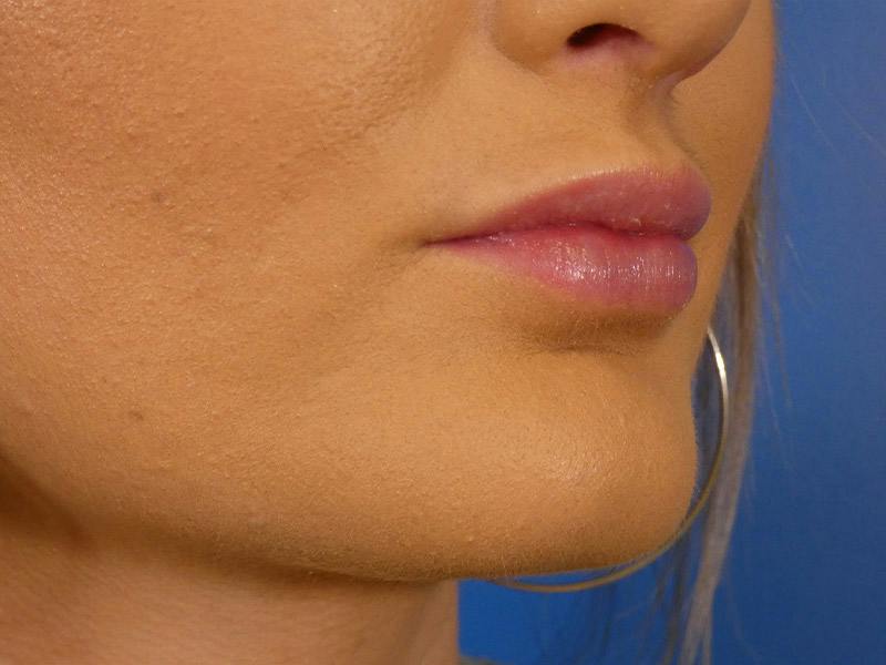 Lip Filler Before & After Gallery - Patient 865840 - Image 4