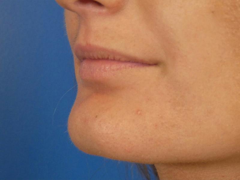 Lip Filler Before & After Gallery - Patient 865840 - Image 5