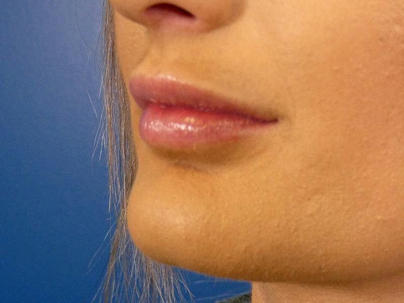 Lip Filler Before & After Gallery - Patient 865840 - Image 6