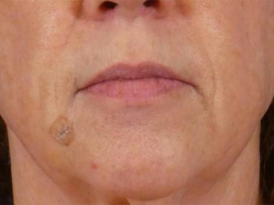 Lip Filler Before & After Gallery - Patient 283649 - Image 1