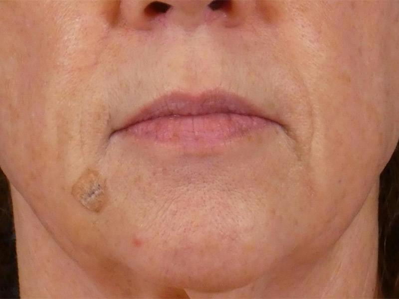Lip Filler Before & After Gallery - Patient 283649 - Image 1