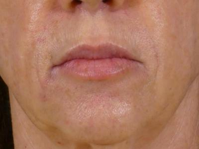 Lip Filler Before & After Gallery - Patient 283649 - Image 2