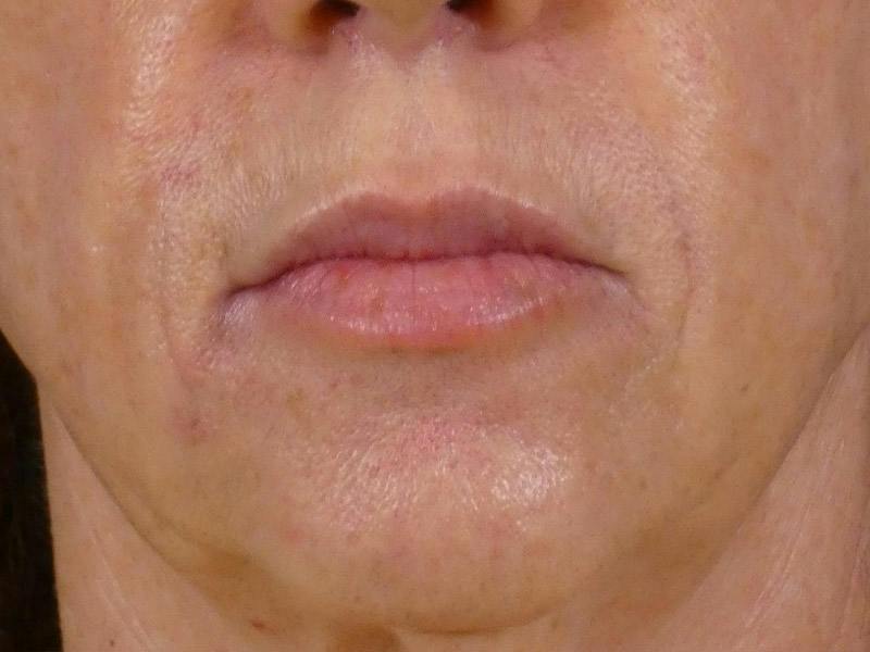 Lip Filler Before & After Gallery - Patient 283649 - Image 2
