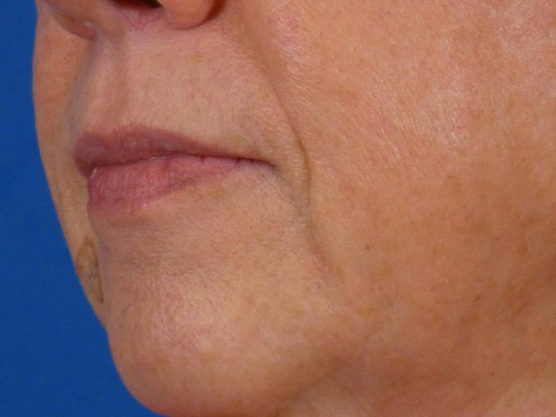 Lip Filler Before & After Gallery - Patient 283649 - Image 3