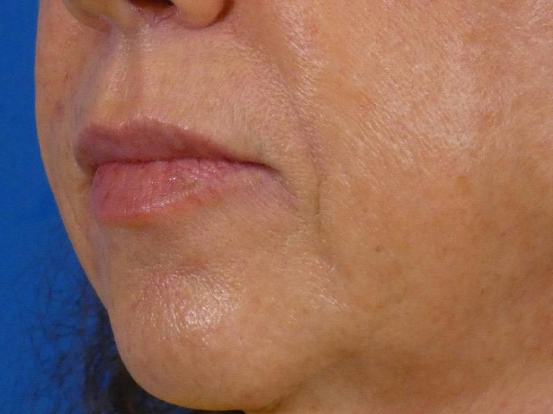 Lip Filler Before & After Gallery - Patient 283649 - Image 4