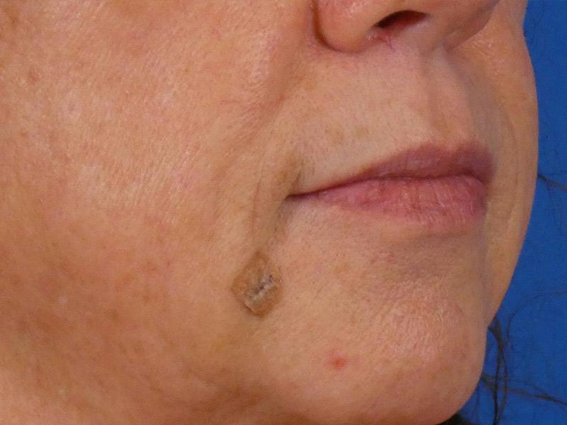 Lip Filler Before & After Gallery - Patient 283649 - Image 5