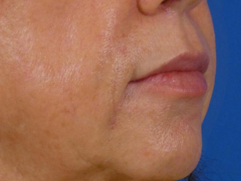 Lip Filler Before & After Gallery - Patient 283649 - Image 6