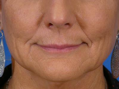 Lip Filler Before & After Gallery - Patient 638153 - Image 1