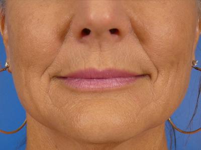 Lip Filler Before & After Gallery - Patient 638153 - Image 2