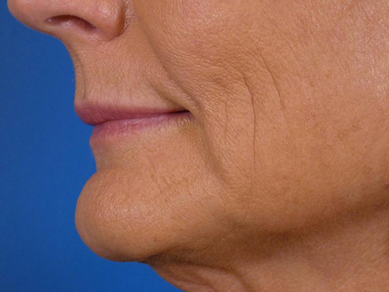 Lip Filler Before & After Gallery - Patient 638153 - Image 3