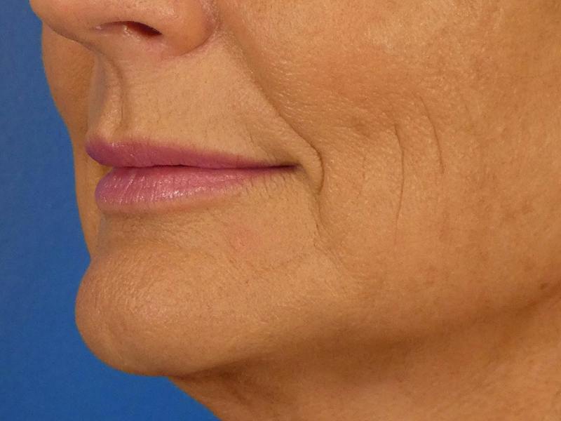 Lip Filler Before & After Gallery - Patient 638153 - Image 4
