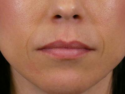 Lip Filler Before & After Gallery - Patient 288818 - Image 1