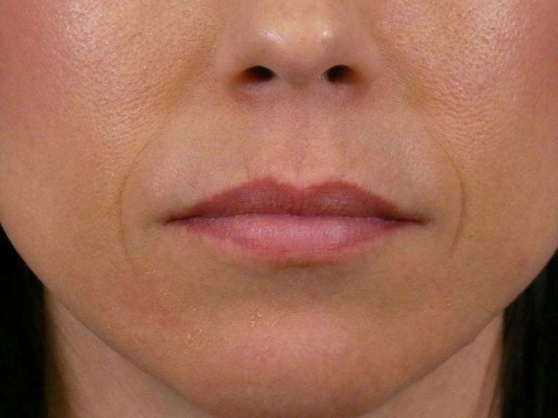 Lip Filler Before & After Gallery - Patient 288818 - Image 1