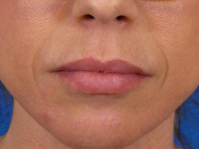 Lip Filler Before & After Gallery - Patient 288818 - Image 2