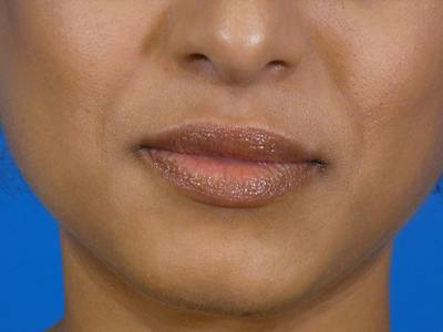 Lip Filler Before & After Gallery - Patient 184594 - Image 1