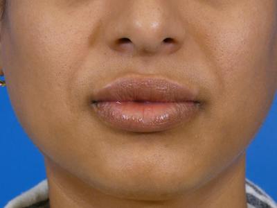 Lip Filler Before & After Gallery - Patient 184594 - Image 2