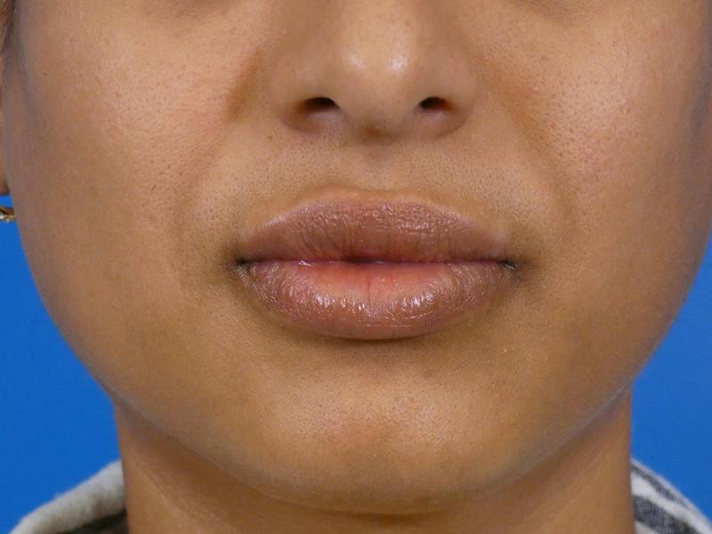 Lip Filler Before & After Gallery - Patient 184594 - Image 2