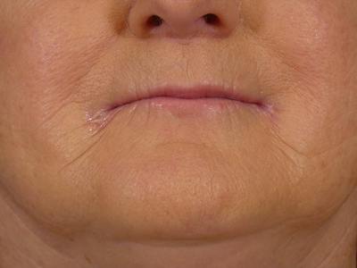 Lip Filler Before & After Gallery - Patient 245077 - Image 1