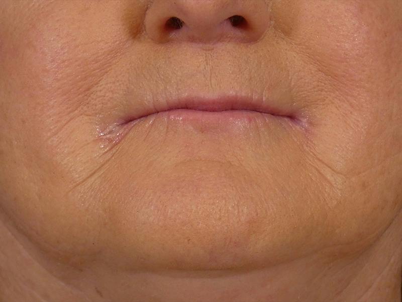 Lip Filler Before & After Gallery - Patient 245077 - Image 1