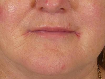 Lip Filler Before & After Gallery - Patient 245077 - Image 2