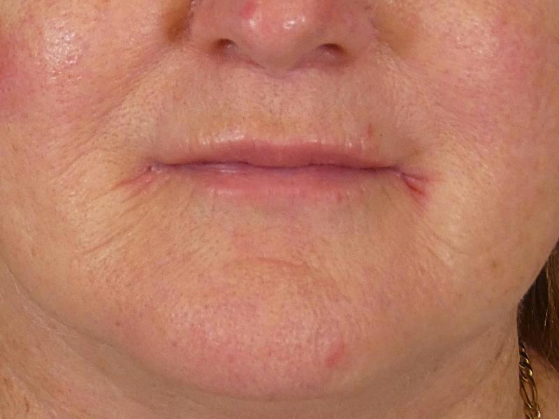 Lip Filler Before & After Gallery - Patient 245077 - Image 2