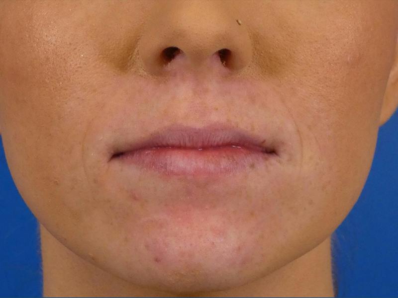Lip Filler Before & After Gallery - Patient 182772 - Image 1