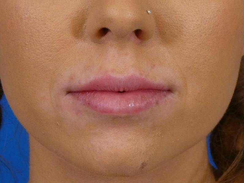 Lip Filler Before & After Gallery - Patient 182772 - Image 2