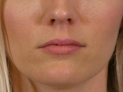 Lip Filler Before & After Gallery - Patient 379547 - Image 1