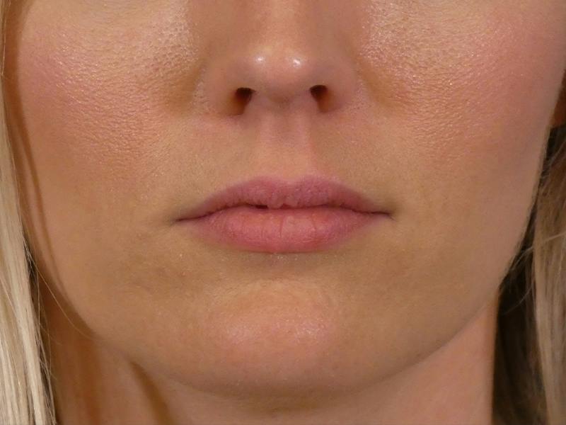 Lip Filler Before & After Gallery - Patient 379547 - Image 1