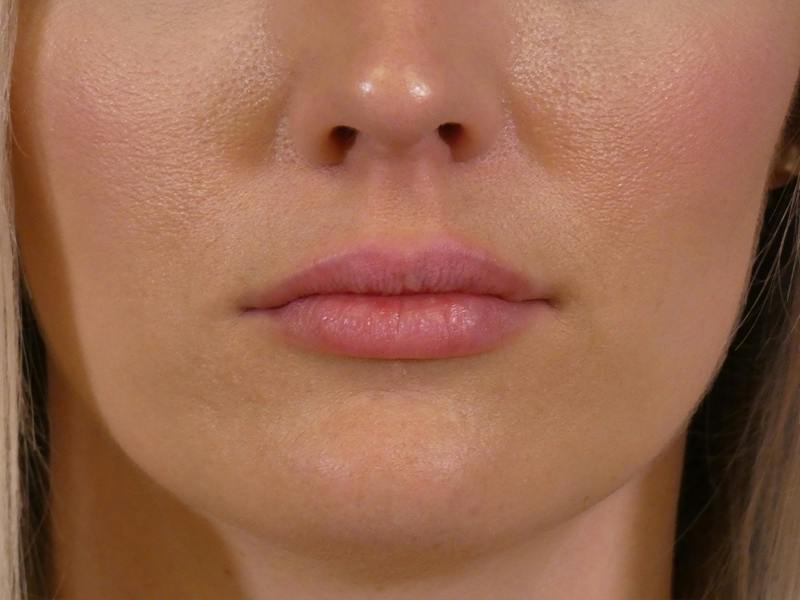 Lip Filler Before & After Gallery - Patient 379547 - Image 2