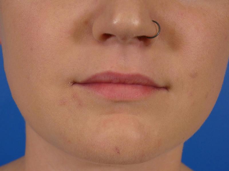 Lip Filler Before & After Gallery - Patient 451515 - Image 1
